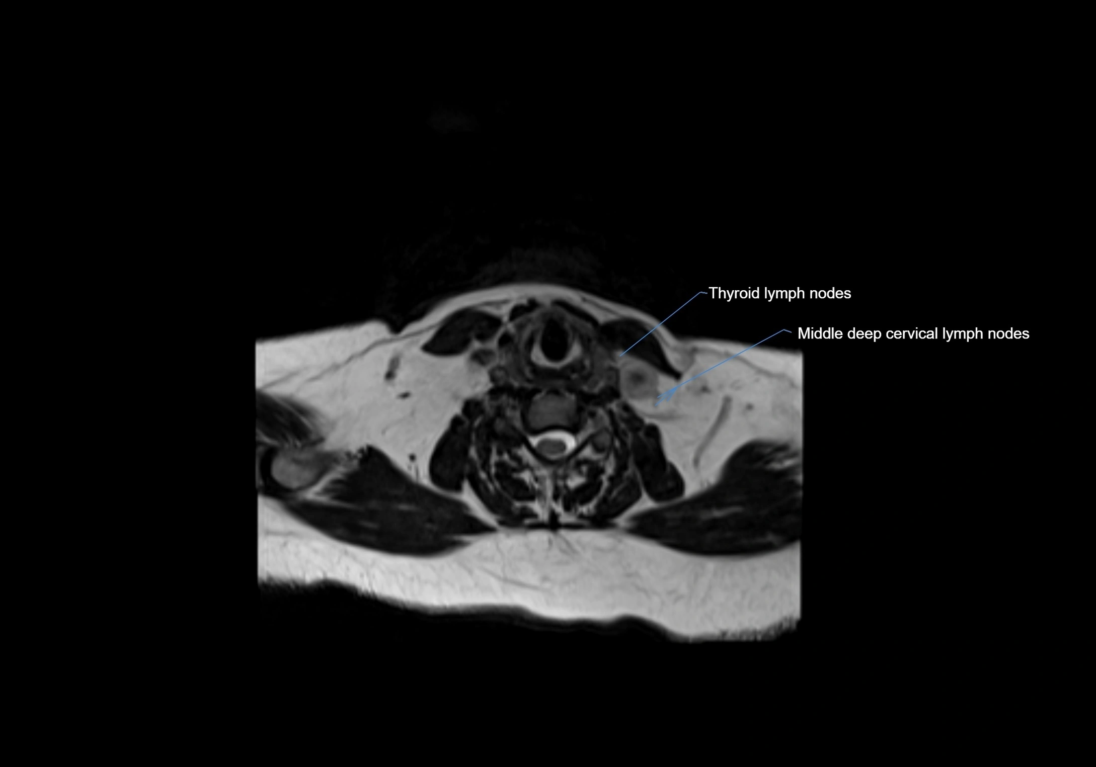 Neck axial  lymph node cross sectional MRI anatomy 3T MRI  image-img-00001-00070.webp